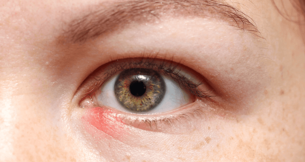 Chalazion : symptômes, causes et remèdes