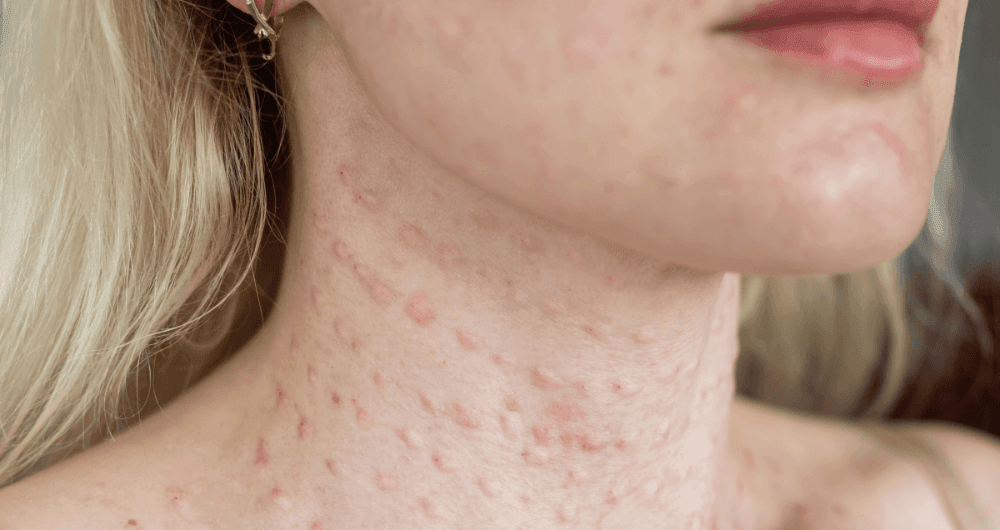 Allergies : les réactions cutanées sur le visage