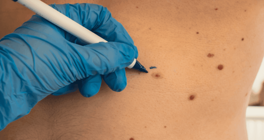 Cancer de la peau : comprendre son évolution