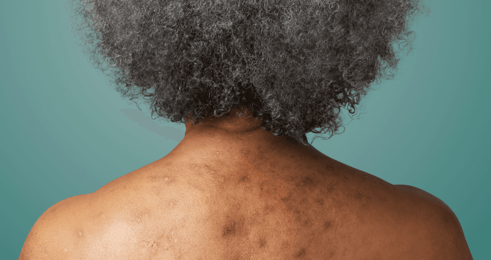 Kératose actinique : comment la reconnaître et la traiter ?