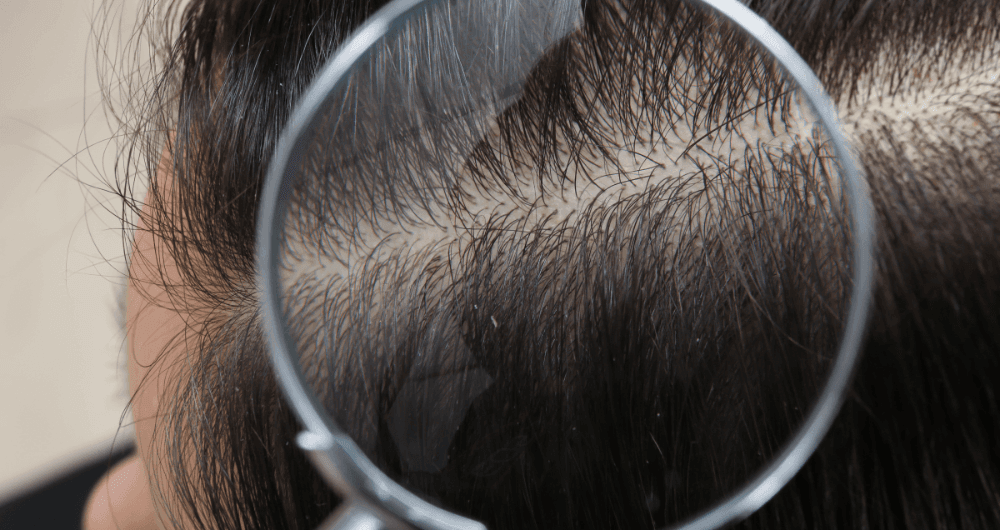Mieux comprendre les maladies du cuir chevelu