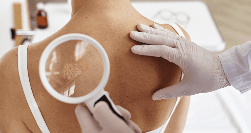 Quels sont les premiers signes d'un cancer de la peau ?