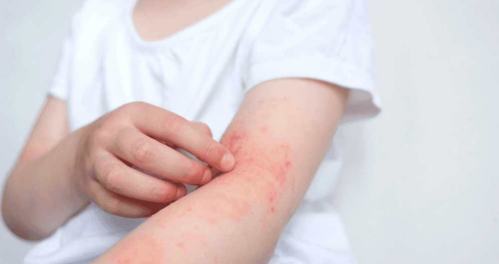 Tout savoir sur les allergies cutanées