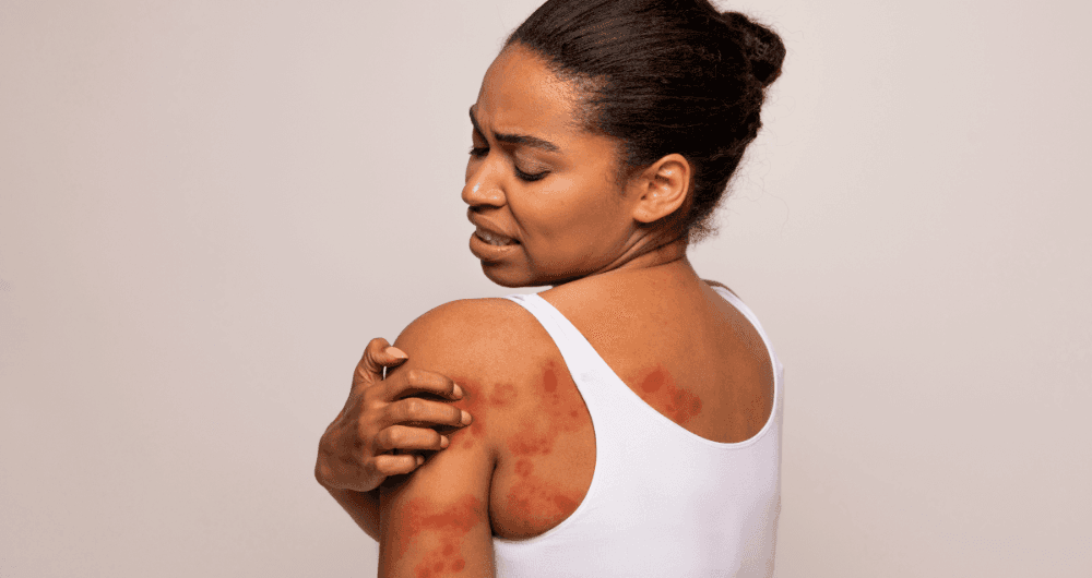 Tâche rouge sur la peau : faut-il s'inquiéter ?